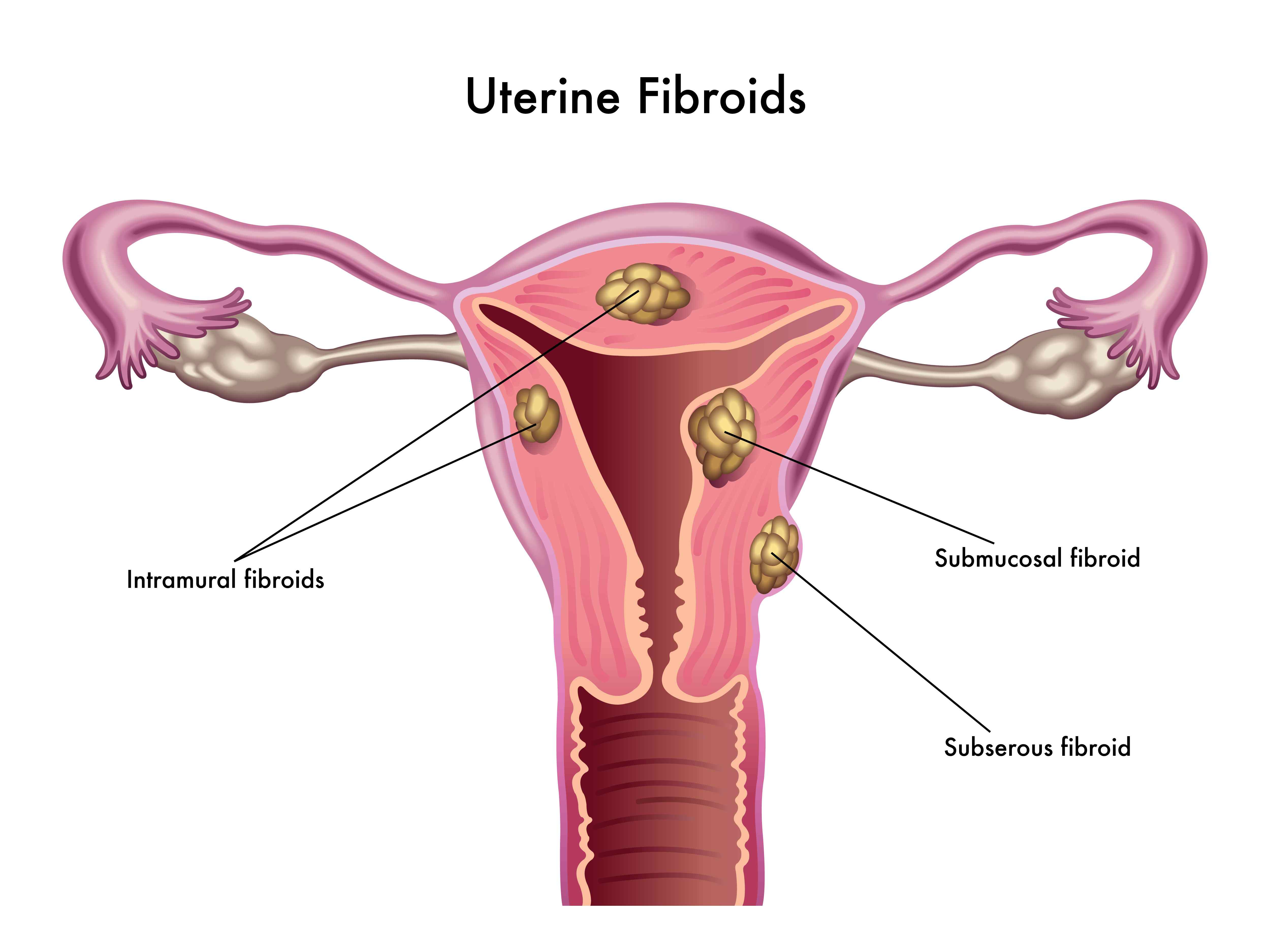 semaglutide and uterine fibroids Fibroids (Leiomyomas) of the Uterus